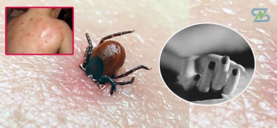  भरतपुर अस्पतालमा ‘स्क्रब टाइफस’ बाट एक महिलाको मृत्यु 